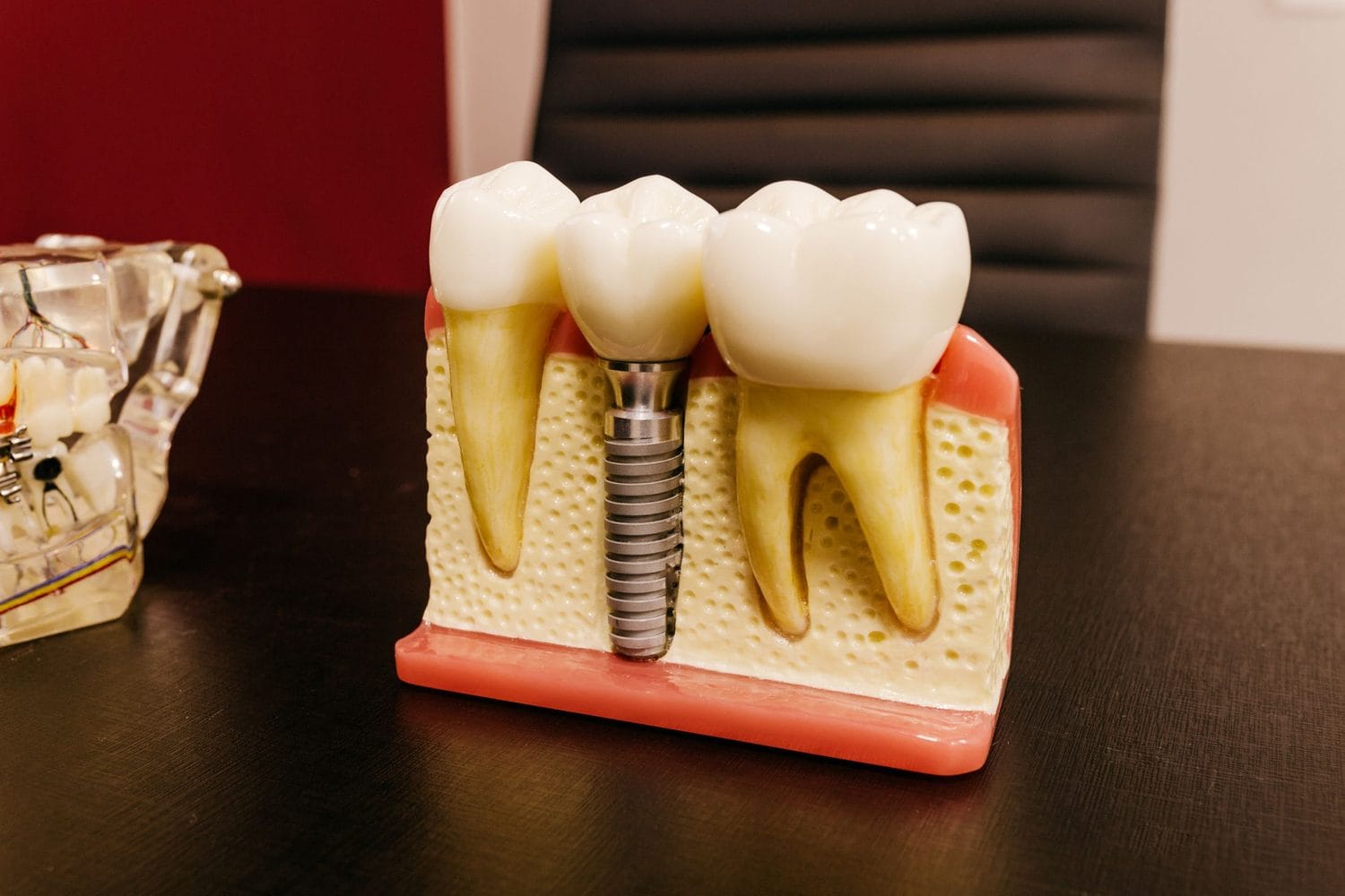 Cutaway jaw model showing a titanium implant post anchored in bone beside natural teeth